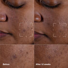 Even Better Clinical&trade Dark Spot Clearing Serum image number null