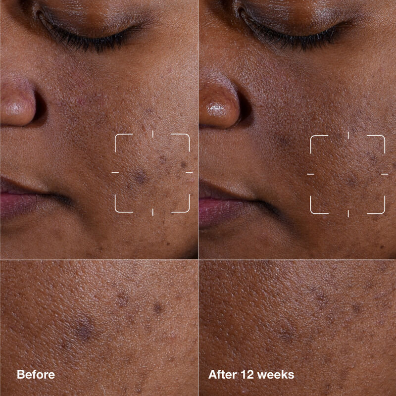 Even Better Clinical&trade Dark Spot Clearing Serum image number null