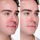 Anti-Blemish Solutions Clinical&trade; Advanced Clearing Gel  image number null